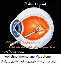 epiretinal membrane Vitrectomy  ویترکتومی در غشاء های روی شبکیه یا مامبران اپی رتینال 